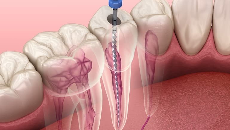 root canal therapy