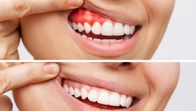 Inflamed Gums Vs Normal Gums