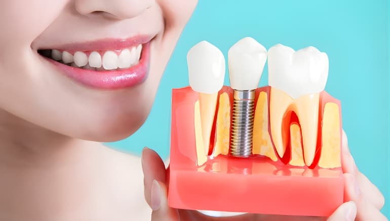 Screwless dental implants procedure