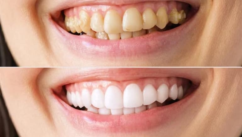 Full Mouth Restoration in Springtown