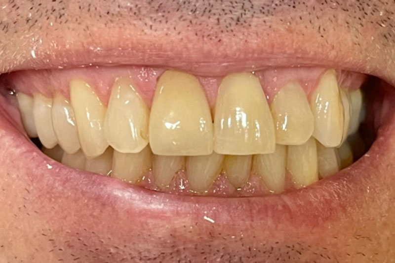 Porcelain Crowns - After