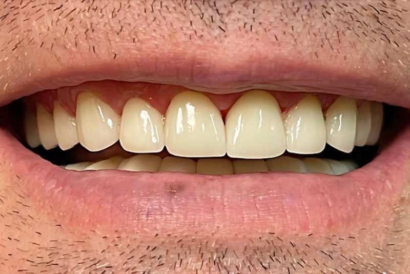 Full Mouth Rehabilitation - After
