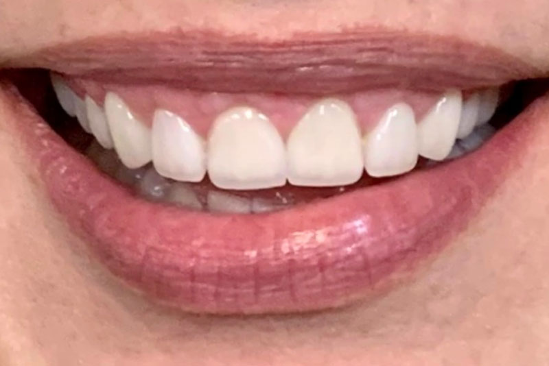 Smile Makeover - After