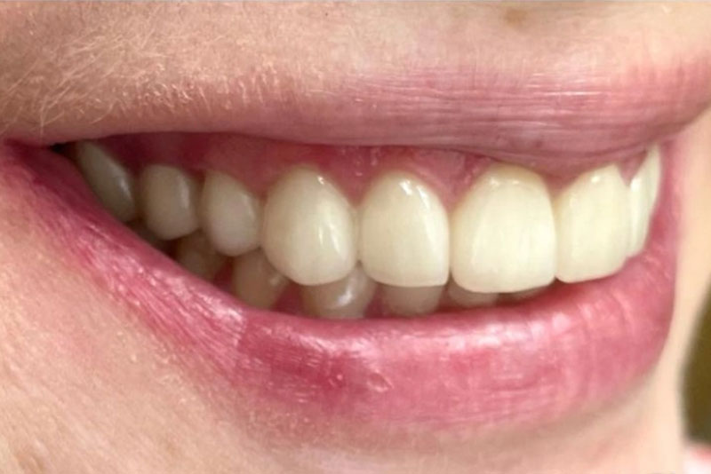 Smile Makeover - After