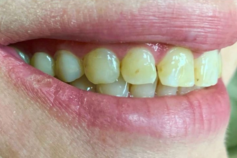 Smile Makeover - Before