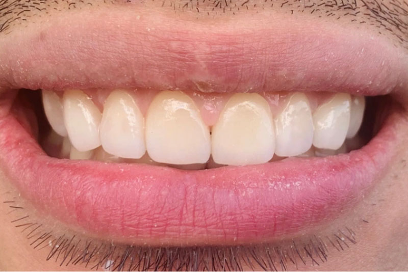 Smile Makeover - After