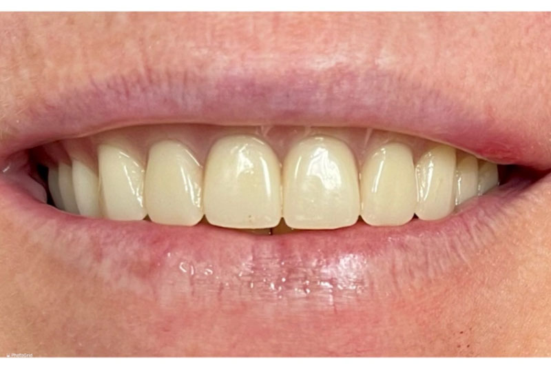 Removable Denture - After