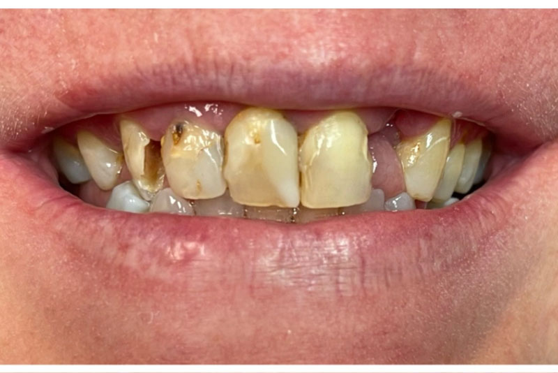 Removable Denture - Before