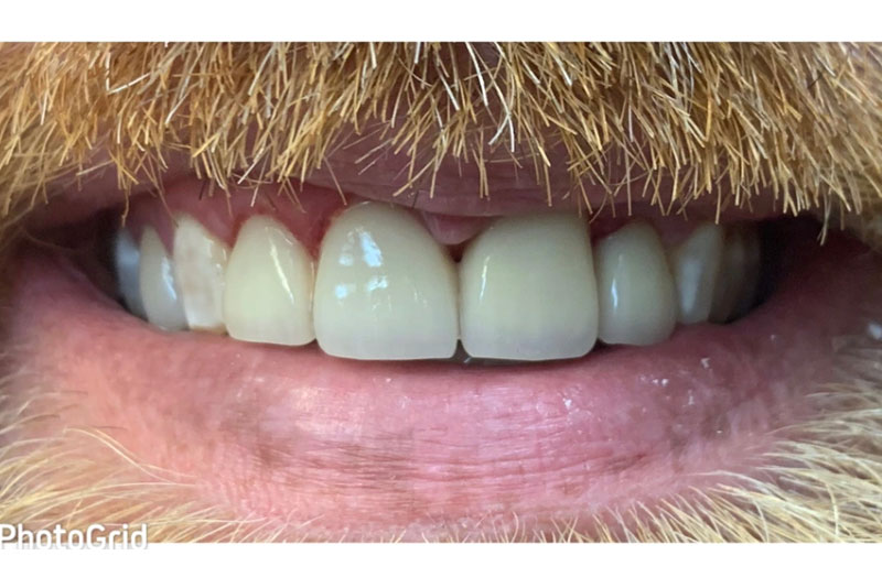 Porcelain Crowns - After