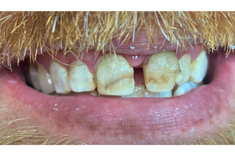 Porcelain Crowns - Before