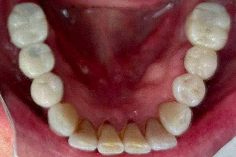 Implants and Crowns - After