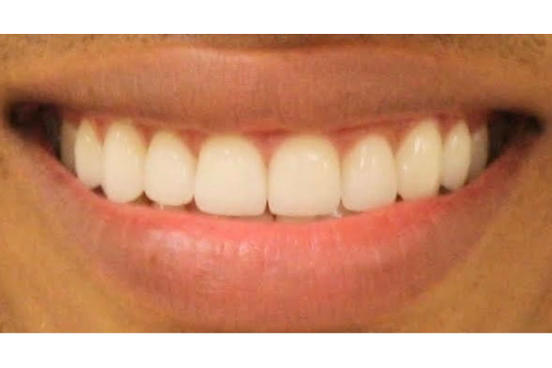 Smile Makeover - After