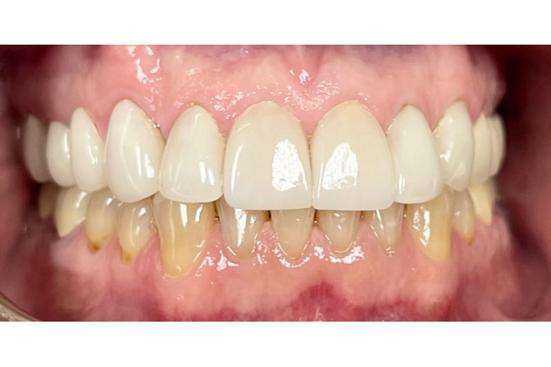 Porcelain Crowns - After