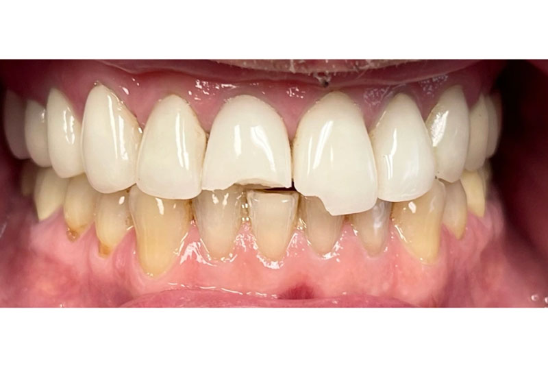 Porcelain Crowns - Before
