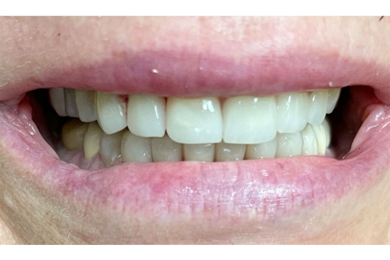 Smile Makeover - After