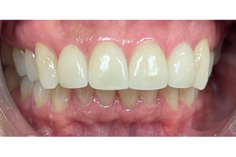 Porcelain Veneers - After