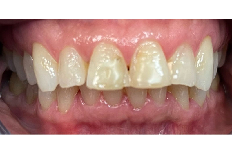 Porcelain Veneers - Before