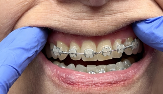 Smile Makeover - After