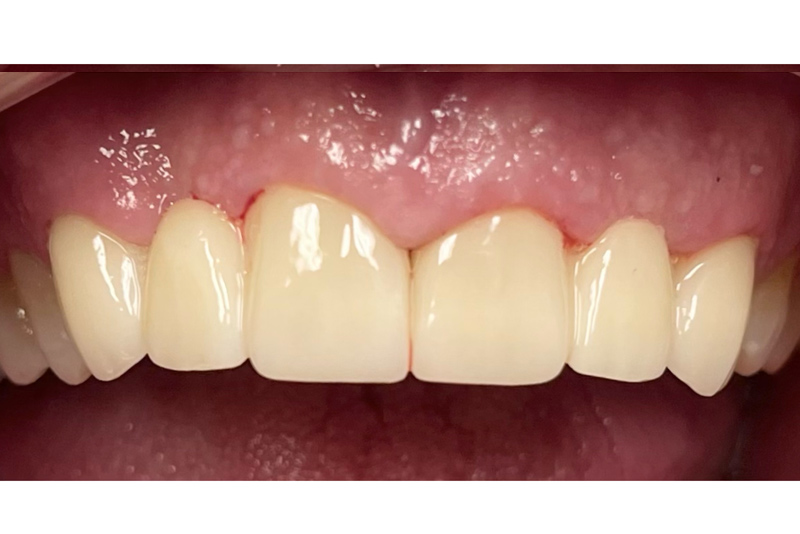 Smile Makeover - After