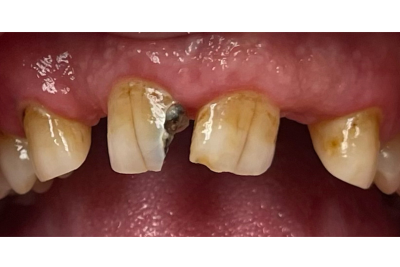 Smile Makeover - Before