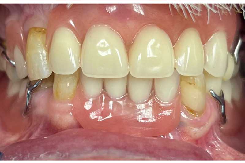 Porcelain Crowns - After