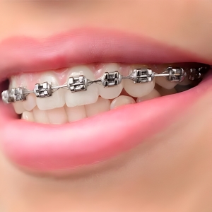 Braces/ClearCorrect
