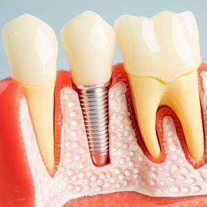 Dental Implants