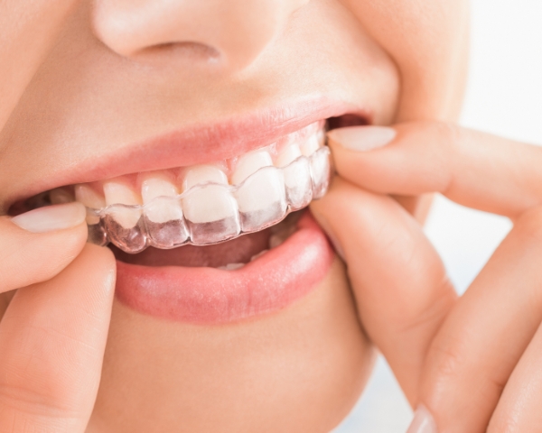 Invisalign®