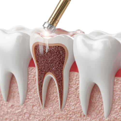 fillings-and-crowns