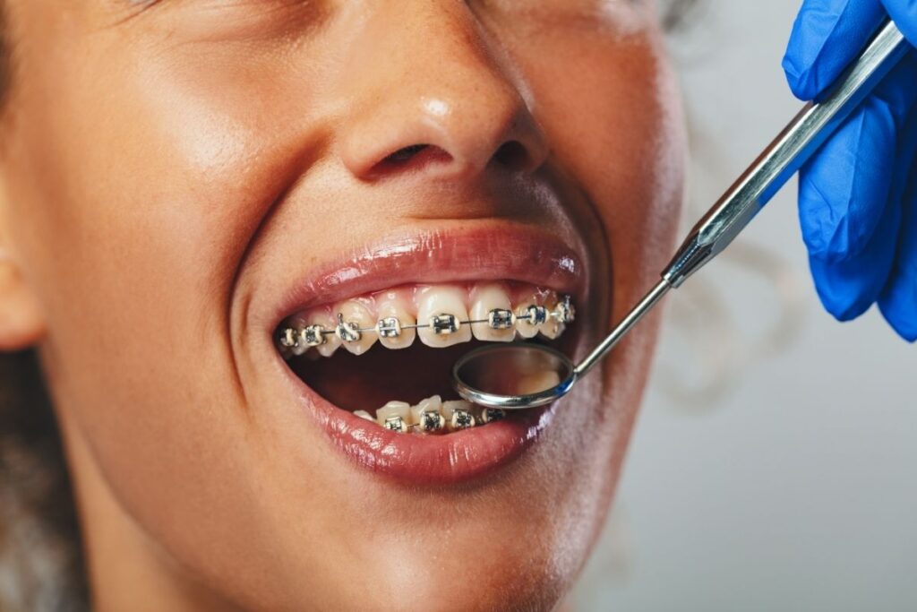 Orthodontic Treatment in Texas