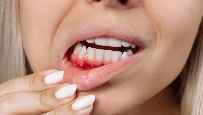 Early Signs of Gum Disease