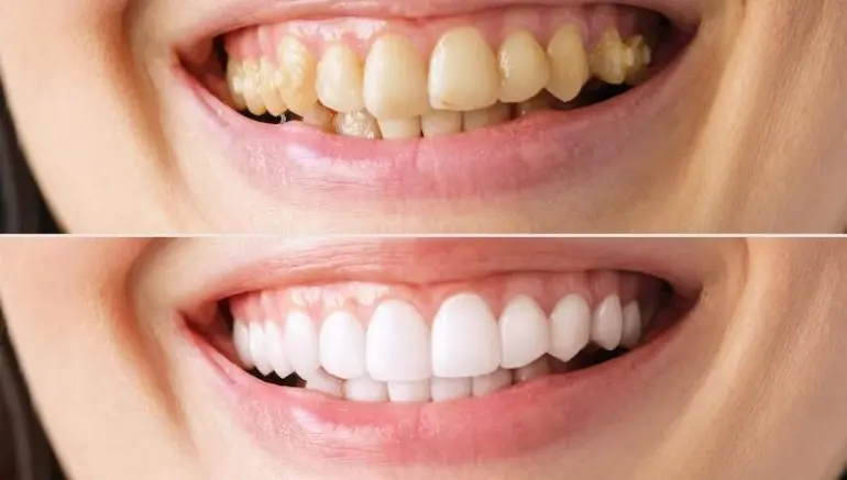Full Mouth Restoration