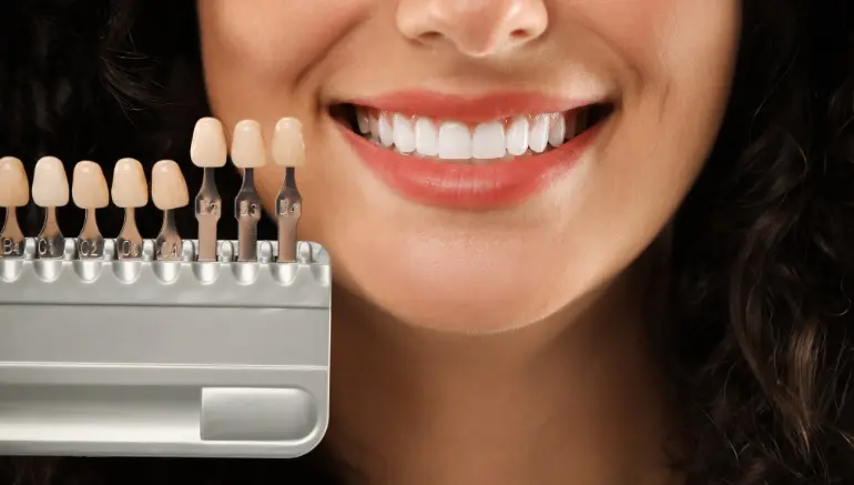 Dental Veneers