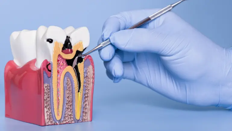 4 Periodontal Treatments
