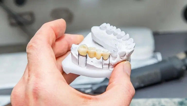 Dental Bridge in dallas