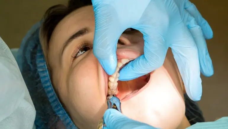 Tooth Extraction