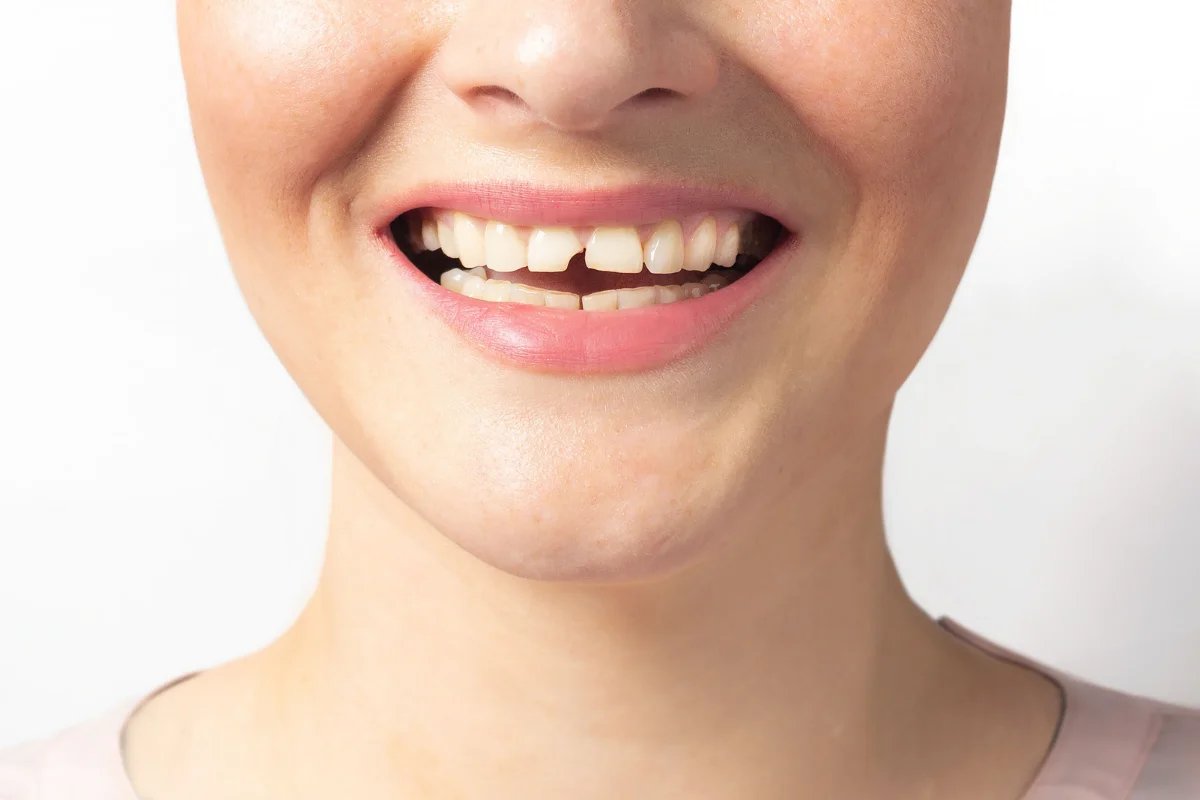 Broken and chipped tooth treatment