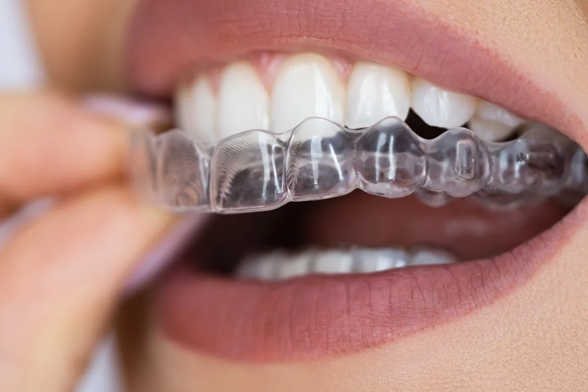 Clear Aligners