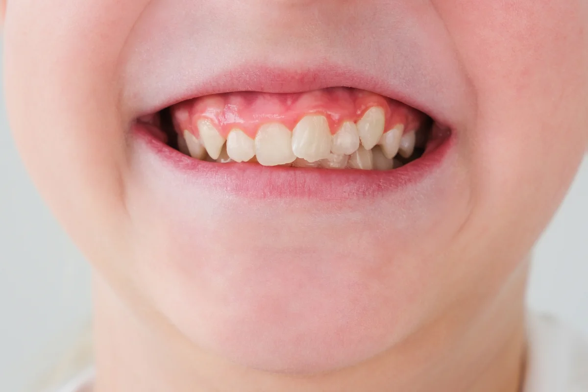 Crooked Teeth