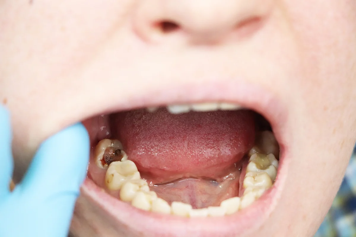 Dental Cavities