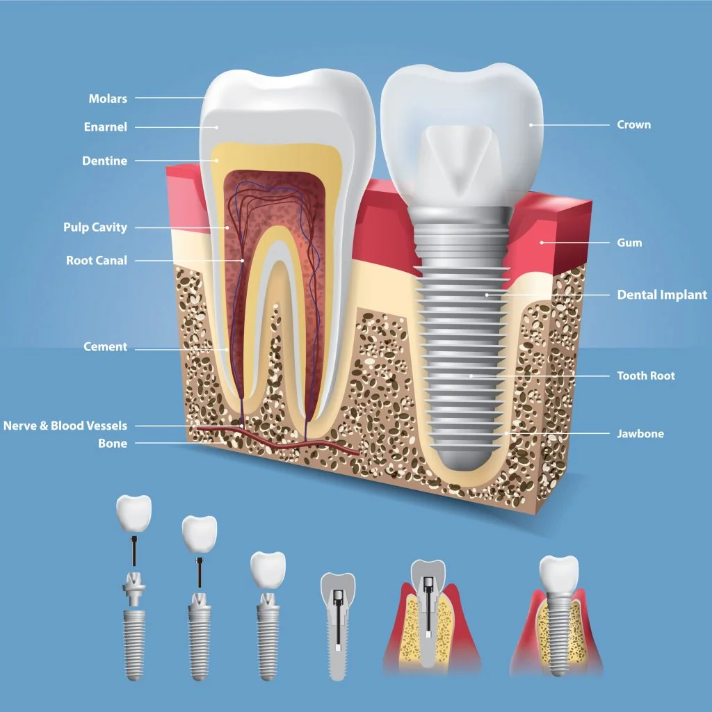 Benefits of Dental Implants