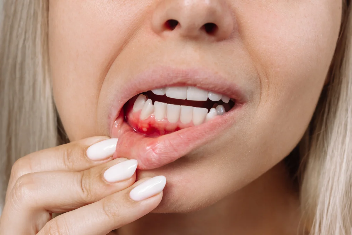 Gum Disease