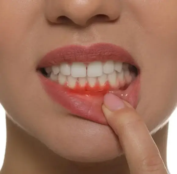 Causes of gum disease