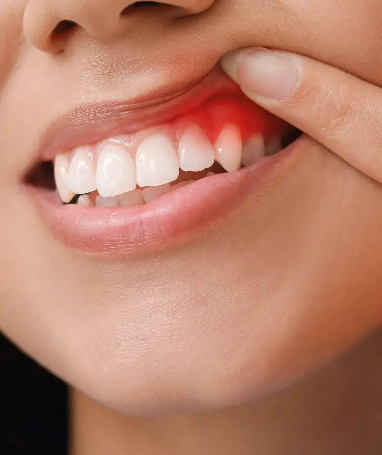 Gum disease treatment in Texas