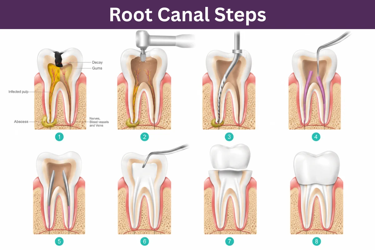 Root Canal Treatment Steps