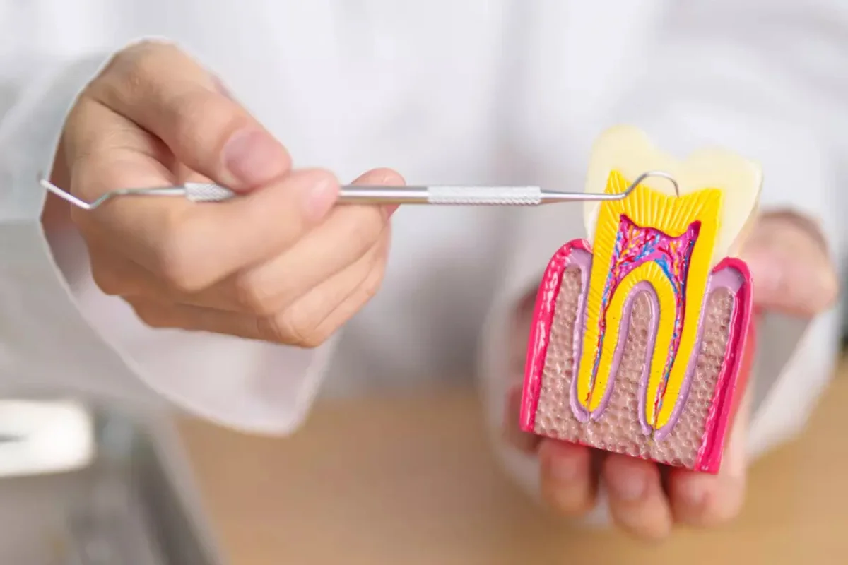 Root Canal