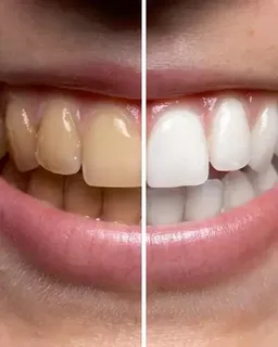 Stained teeth treatment in Texas