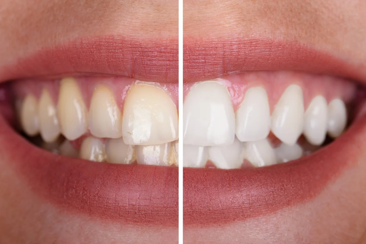 Teeth Cleaning and Whitening