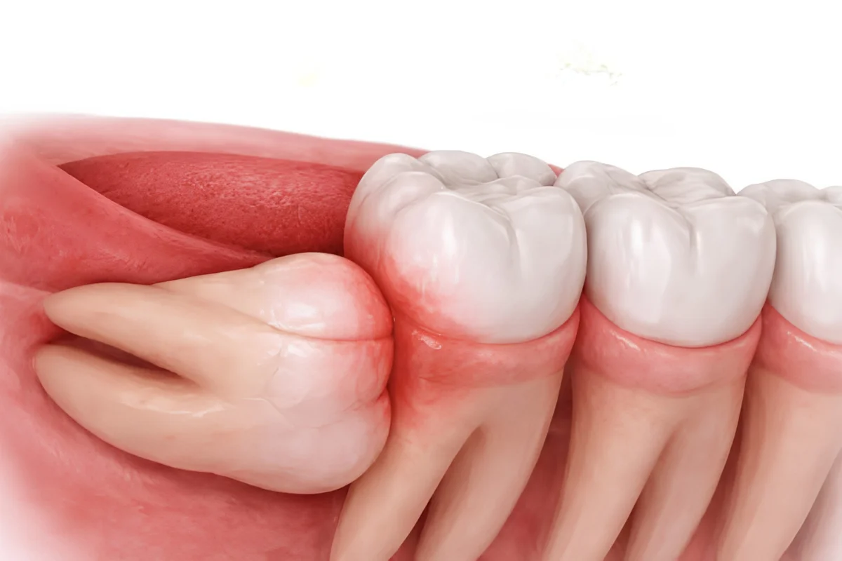 Wisdom Teeth
