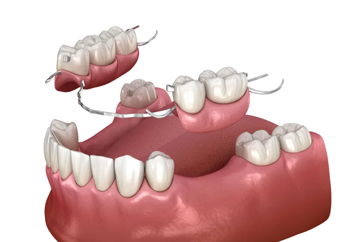 Dentures